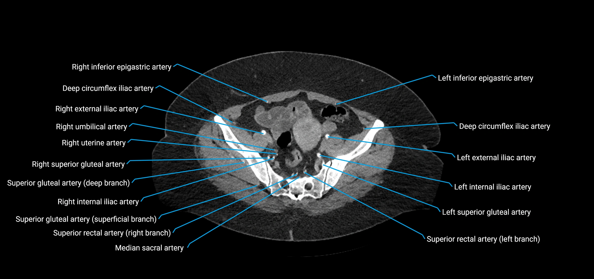CTA abdomen axial cross sectional anatomy labelled image_204 (2).webp